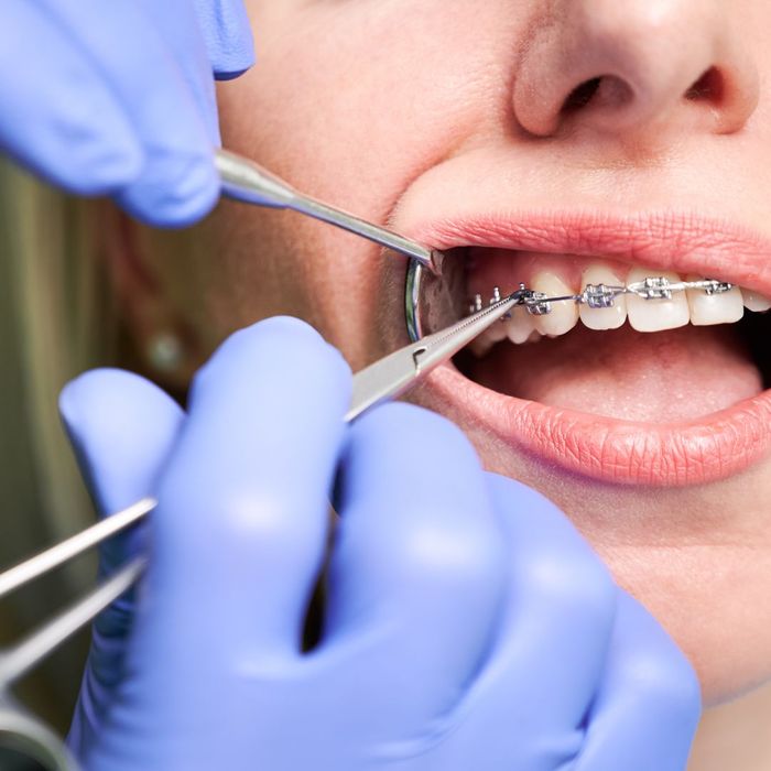 Do Orthodontists Still Extract Teeth for Braces? Debunking Common Misc